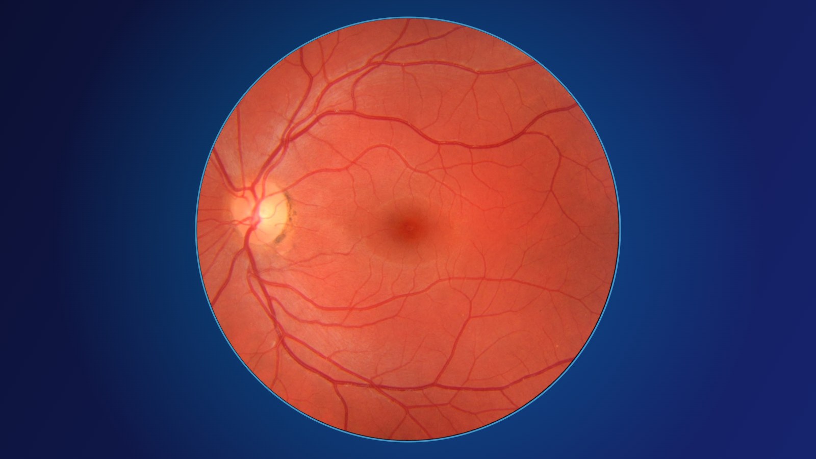 Descolamento de retina: os 3 sinais de alerta que não podem esperar